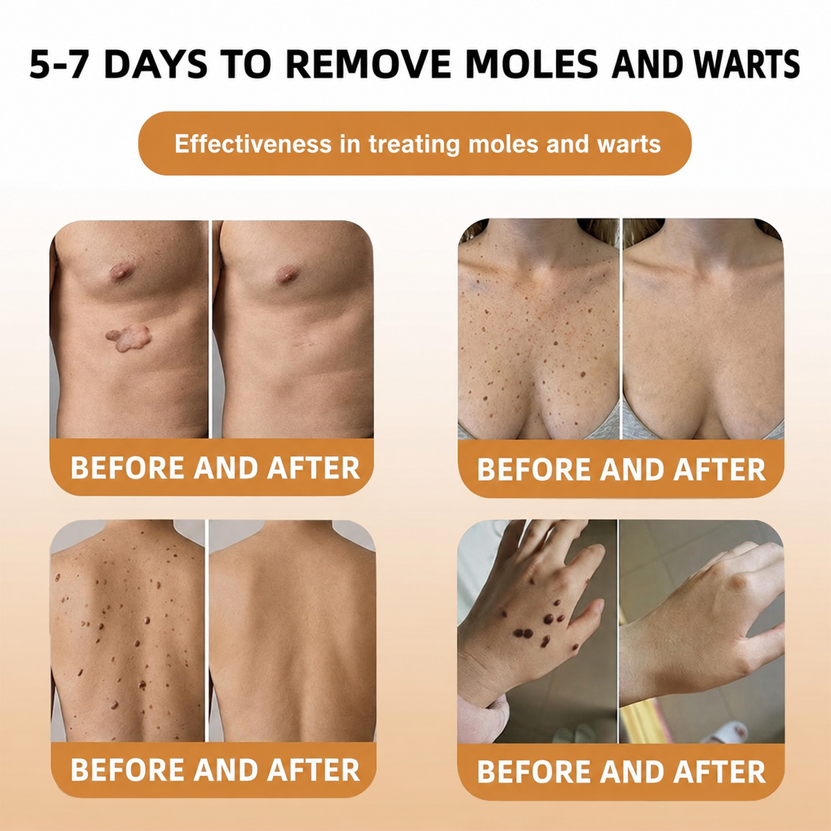 🐝 Turonu® Advanced Bee Venom Treatment for Warts and Skin Imperfections 👨‍⚕️ Inspired by dermatological science | Targeted care at home