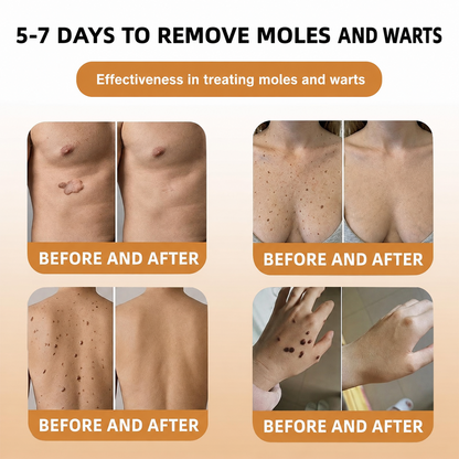 🐝 Turonu® Advanced Bee Venom Treatment for Warts and Skin Imperfections 👨‍⚕️ Inspired by dermatological science | Targeted care at home