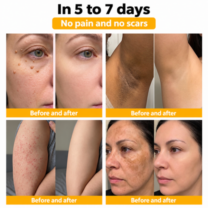 🐝 Turonu® Advanced Bee Venom Treatment for Warts and Skin Imperfections 👨‍⚕️ Inspired by dermatological science | Targeted care at home