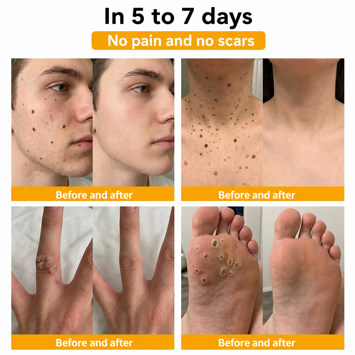 🐝 Turonu® Advanced Bee Venom Treatment for Warts and Skin Imperfections 👨‍⚕️ Inspired by dermatological science | Targeted care at home