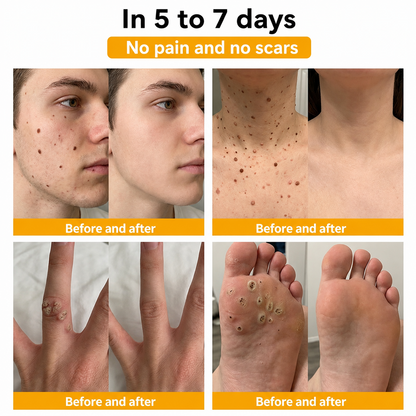 🐝 Turonu® Advanced Bee Venom Treatment for Warts and Skin Imperfections 👨‍⚕️ Inspired by dermatological science | Targeted care at home