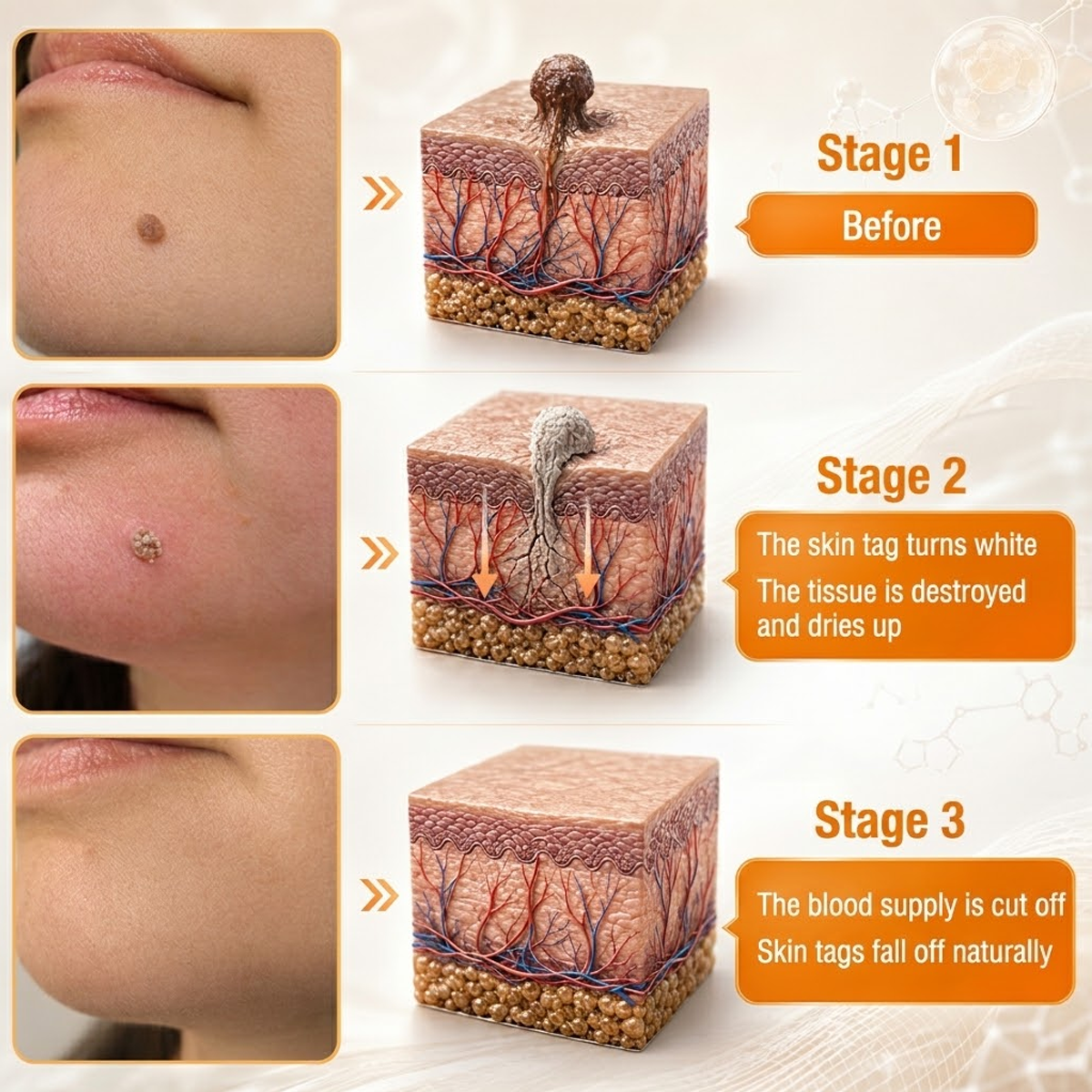 🐝 Turonu® Advanced Bee Venom Treatment for Warts and Skin Imperfections 👨‍⚕️ Inspired by dermatological science | Targeted care at home