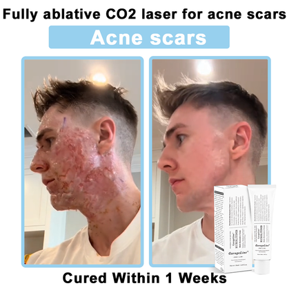 【GarageLine® Official Store】JAK-Smart Ruxolitinib Repair Complex 👨‍⚕️（Zero Inflammation, 72H Sustained Release | Acne Clear in 10 Days | 97.7% Redness Reduction | Clinically Tested）