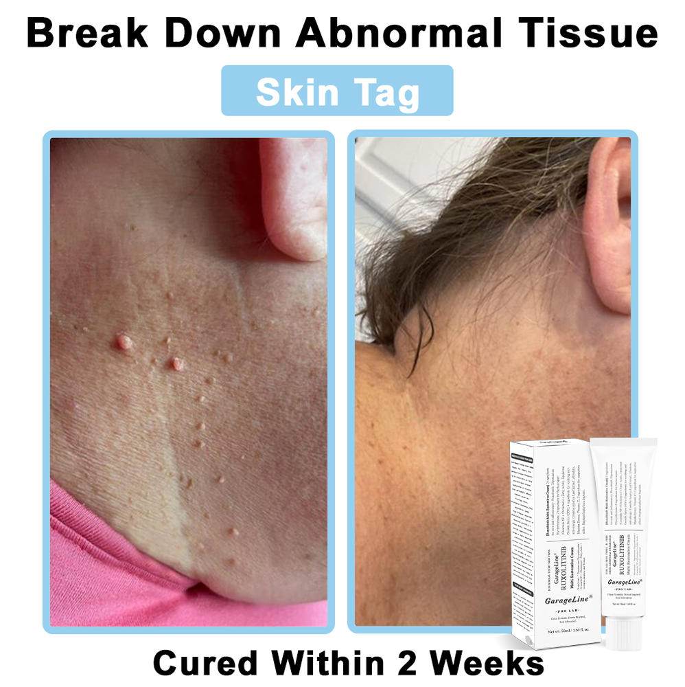 【GarageLine® Official Store】JAK-Smart Ruxolitinib Repair Complex 👨‍⚕️（Zero Inflammation, 72H Sustained Release | Acne Clear in 10 Days | 97.7% Redness Reduction | Clinically Tested）