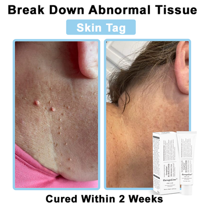 【GarageLine® Official Store】JAK-Smart Ruxolitinib Repair Complex 👨‍⚕️（Zero Inflammation, 72H Sustained Release | Acne Clear in 10 Days | 97.7% Redness Reduction | Clinically Tested）