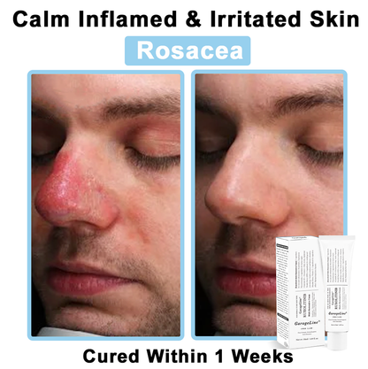 【GarageLine® Official Store】JAK-Smart Ruxolitinib Repair Complex 👨‍⚕️（Zero Inflammation, 72H Sustained Release | Acne Clear in 10 Days | 97.7% Redness Reduction | Clinically Tested）