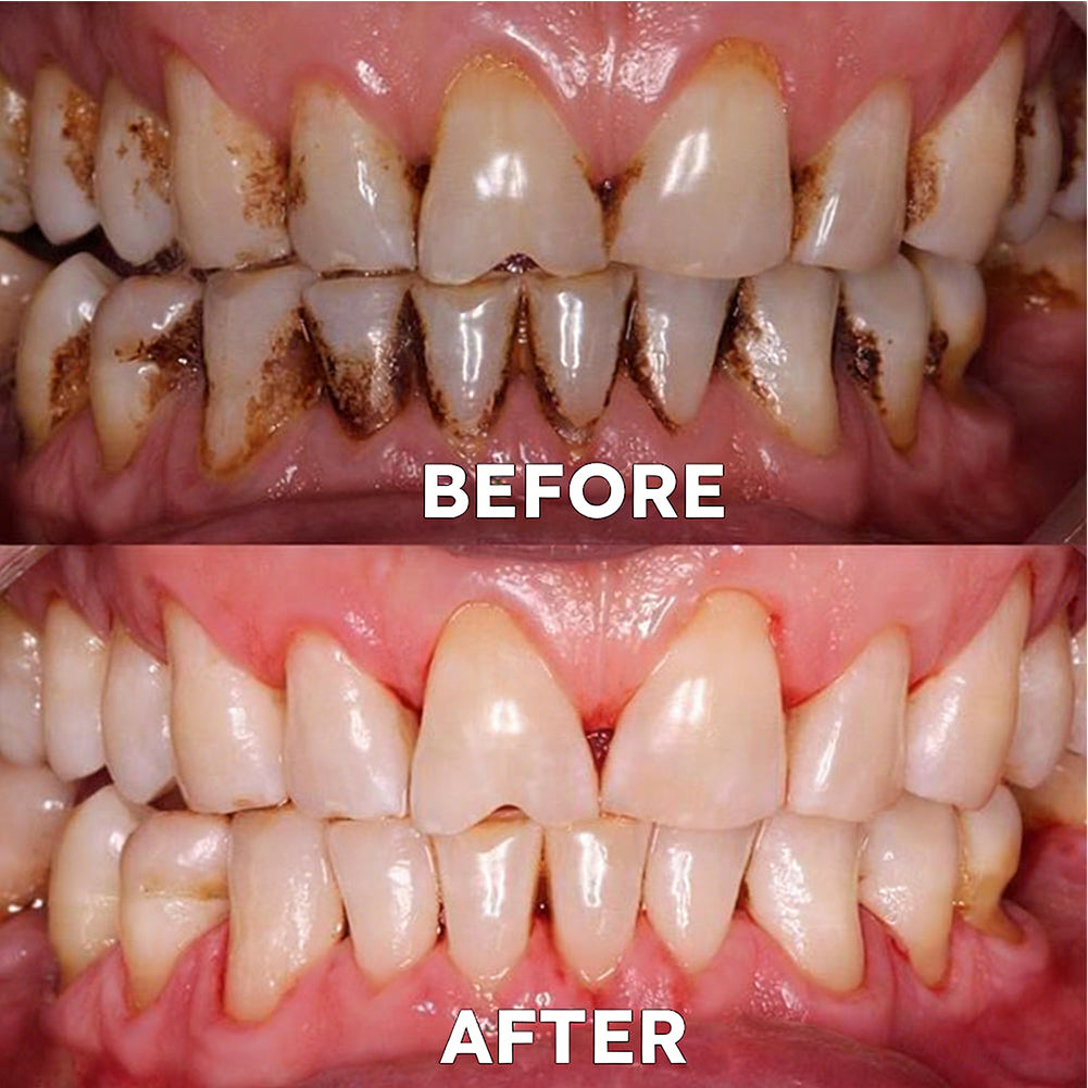 ✅Official Store |🦷GarageLine® Nano-Hydroxyapatite Purple Whitening Strips - Professional Enamel Care & Brightening