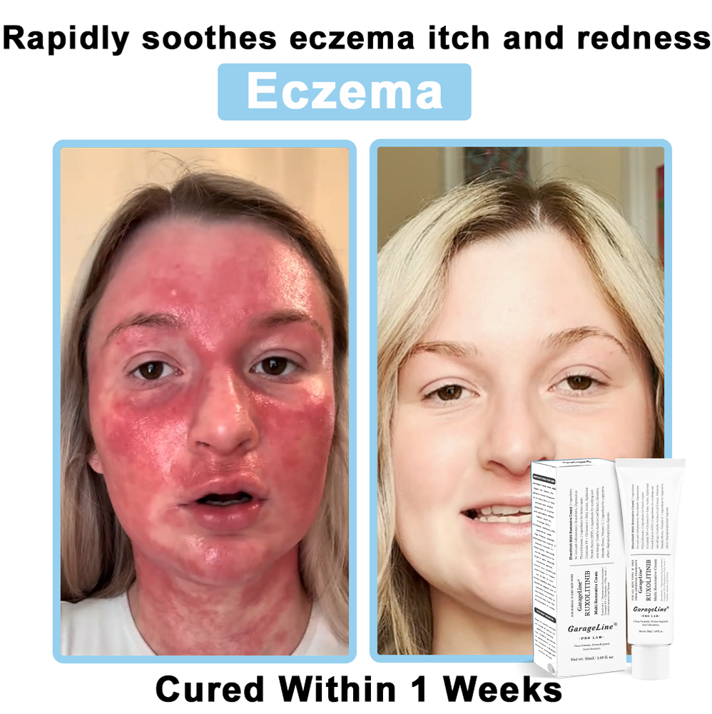 【GarageLine® Official Store】JAK-Smart Ruxolitinib Repair Complex 👨‍⚕️（Zero Inflammation, 72H Sustained Release | Acne Clear in 10 Days | 97.7% Redness Reduction | Clinically Tested）
