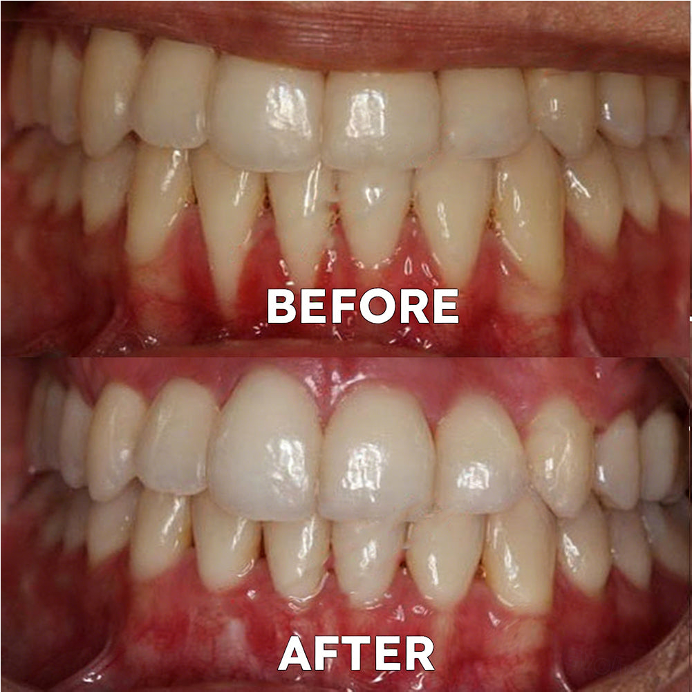 ✅Official Store |🦷GarageLine® Nano-Hydroxyapatite Purple Whitening Strips - Professional Enamel Care & Brightening