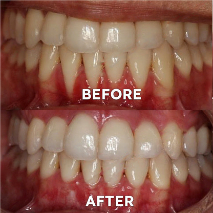 ✅Official Store |🦷GarageLine® Nano-Hydroxyapatite Purple Whitening Strips - Professional Enamel Care & Brightening