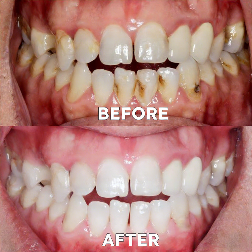 ✅Official Store |🦷GarageLine® Nano-Hydroxyapatite Purple Whitening Strips - Professional Enamel Care & Brightening