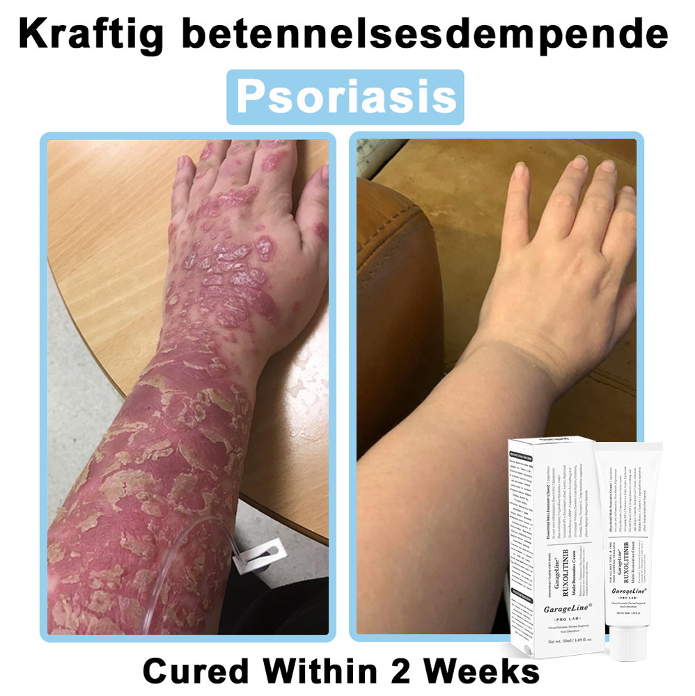 【GarageLine® Official Store】JAK-Smart Ruxolitinib Repair Complex 👨‍⚕️（Zero Inflammation, 72H Sustained Release | Acne Clear in 10 Days | 97.7% Redness Reduction | Clinically Tested）