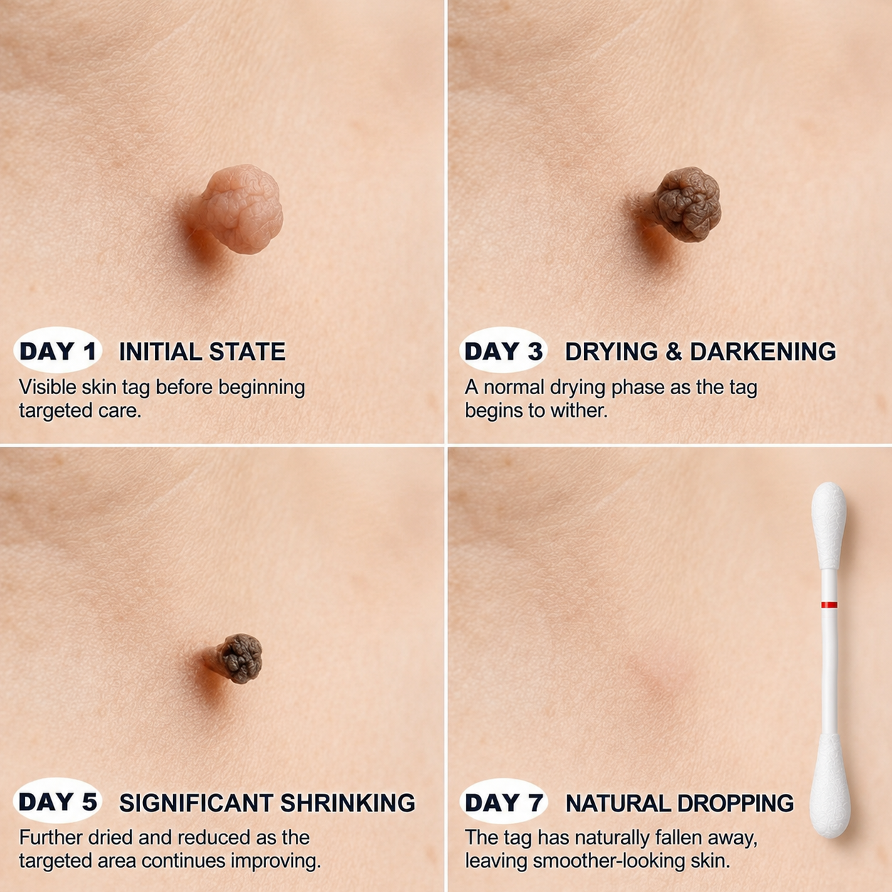 🔥🔥CureVivo® 👩‍⚕️7-Day 𝗦𝐤𝐢𝐧 𝐓𝐚𝐠 & 𝗪𝐚𝐫𝐭 𝐂𝐚𝐫𝐞 𝐏𝐫𝐞𝐜𝐢𝐬𝐢𝐨𝐧 𝐒𝐰𝐚𝐛𝐬（Individually Sealed, Single-Use）💪