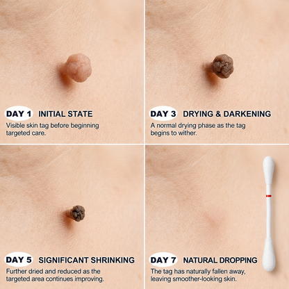 🔥🔥CureVivo® 👩‍⚕️7-Day 𝗦𝐤𝐢𝐧 𝐓𝐚𝐠 & 𝗪𝐚𝐫𝐭 𝐂𝐚𝐫𝐞 𝐏𝐫𝐞𝐜𝐢𝐬𝐢𝐨𝐧 𝐒𝐰𝐚𝐛𝐬（Individually Sealed, Single-Use）💪