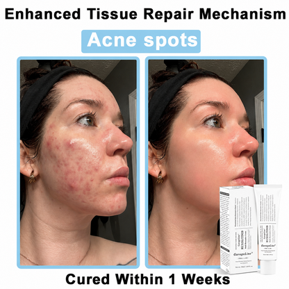 【GarageLine® Official Store】JAK-Smart Ruxolitinib Repair Complex 👨‍⚕️（Zero Inflammation, 72H Sustained Release | Acne Clear in 10 Days | 97.7% Redness Reduction | Clinically Tested）