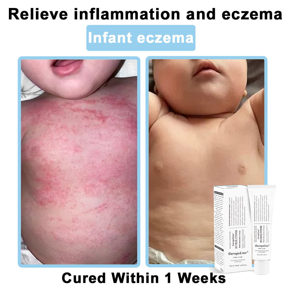 【GarageLine® Official Store】JAK-Smart Ruxolitinib Repair Complex 👨‍⚕️（Zero Inflammation, 72H Sustained Release | Acne Clear in 10 Days | 97.7% Redness Reduction | Clinically Tested）