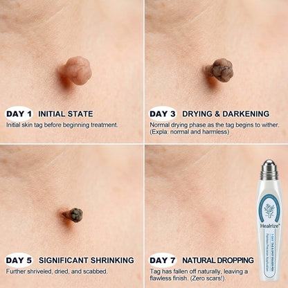 🔥🔥𝐇𝐞𝐚𝐥𝐫𝐢𝐳𝐞® 👩‍⚕️7-𝐷𝑎𝑦 𝗧𝐚𝐠 & 𝗦𝗽𝐨𝐭 𝐄𝐫𝒂𝒔𝒆𝒓(Zero Pain, Zero 𝐒𝐜𝐚𝒓𝒔 Rollerball)💪